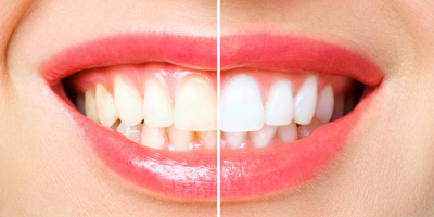 Teeth whitening with dental work crowns veneers College Street Dentistry Toronto