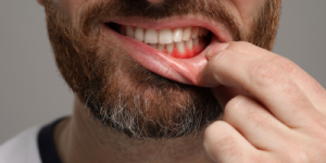 Dentist on College Street performing gum disease treatment at College Street Dentistry Toronto
