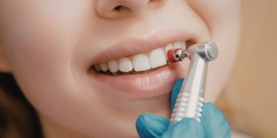 Kids dentist applying dental sealants at College Street Dentistry Toronto office